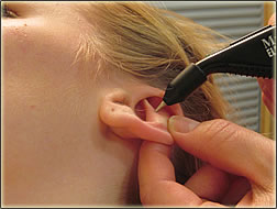 Ohrakupunktur, Elektroohrakupunktur